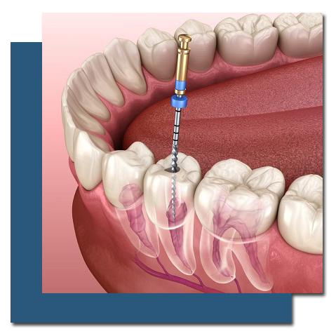 Root Canal Treatment